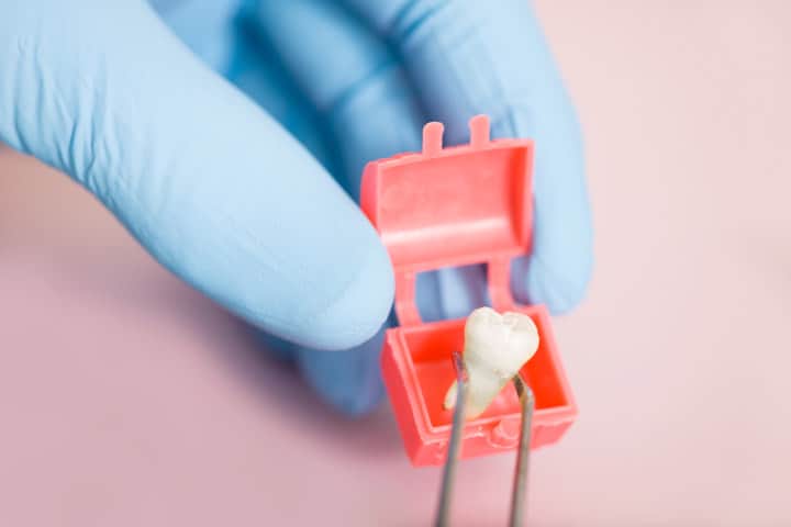 M Dental Practice - Naše usluge - Vađenje zuba