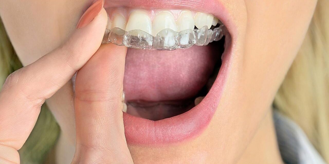 https://mdentalpractice.com/wp-content/uploads/2021/02/m-dental-practice-stomatoloska-ordinacija-portal-za-pacijente-bruksizam-1280x640.jpg